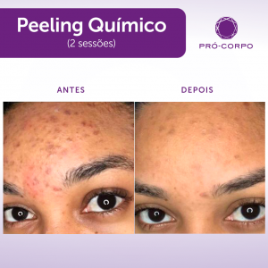 peeling-quimico-marcas-acne-fotos-antes-depois